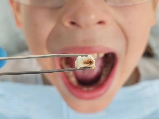Best Emergency Root Canal Treatment in East Cleveland, OH